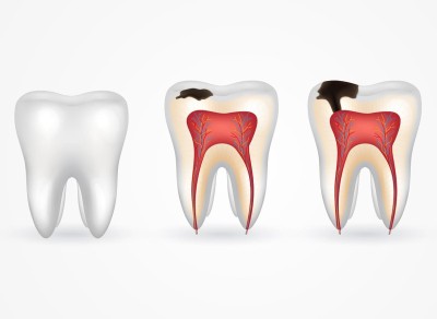 Caries Treatment