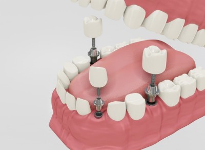 Implant Over Prosthesis